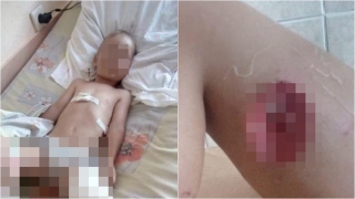 Под Саратовом алабай покусал трехлетнего мальчика