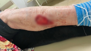 "Выдрала клок мяса с ноги". В Заводском районе бродячая собака напала на женщину