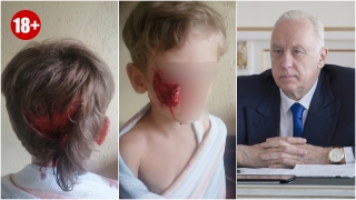 В Саратове собака депутата покусала ребенка. Глава СК взял проверку на контроль