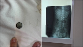 В Балакове врачи спасли проглотившего батарейку годовалого ребенка