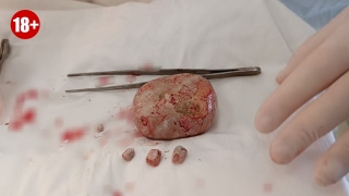 Саратовские врачи извлекли килограммовый камень из мочевого пузыря пациента