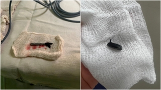 Наконечник кисти в щеке и башмачок в носу. Саратовские врачи рассказали о спасении малышей