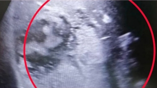 Из печени пожилого саратовца врачи откачали целый литр гноя