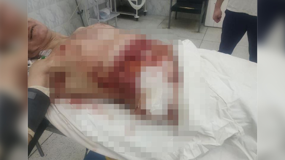 "Собирали по частям": саратовские врачи спасли пациента с 15 колото-резаными ранами